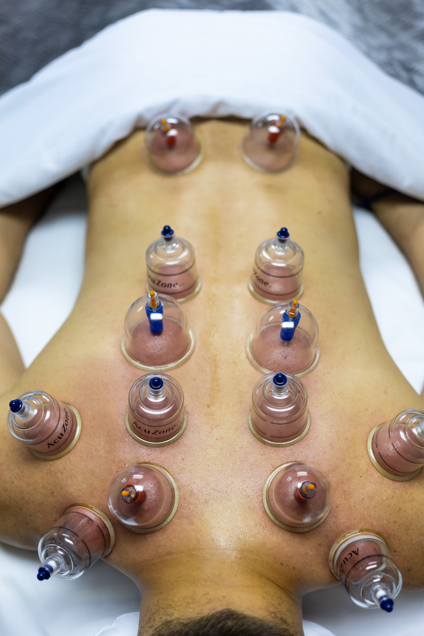 Cupping Therapy